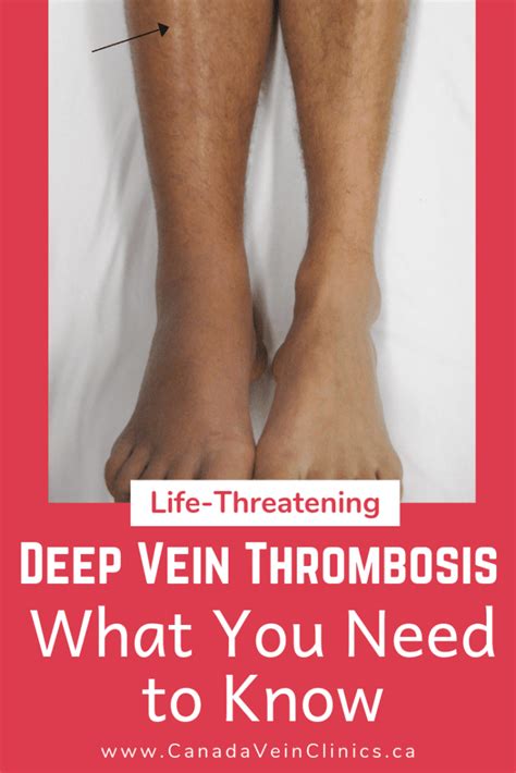 Deep Vein Thrombosis Dvt Complications Of Varicose Veins Canada