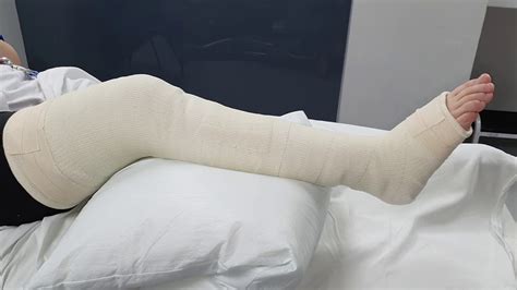 Care Of An Above Knee Cast Youtube