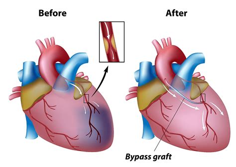 Coronary Artery What Is A Coronary Artery Bypass Graft