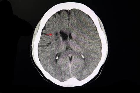 Ct Brain Of A Stroke Patient Stock Image Image Of Infarct Atrophy