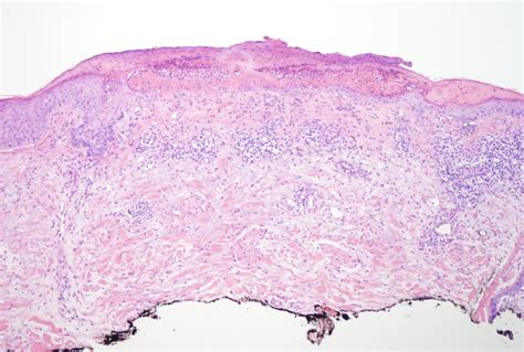 Melanoma In Situ With Ulcer Dermatopathology