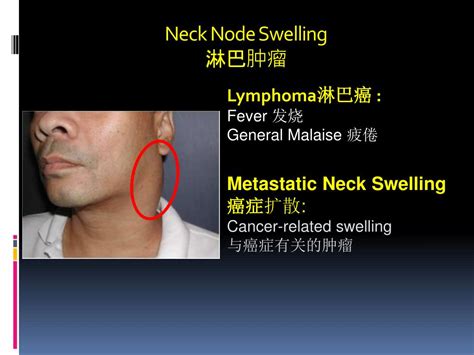 It could be an infection, but it's also an early warning of mouth, throat, thyroid, and voice box (larynx) cancers. PPT - Signs and Symptoms of Head & Neck Cancers 头部与頚部癌症的症状 ...