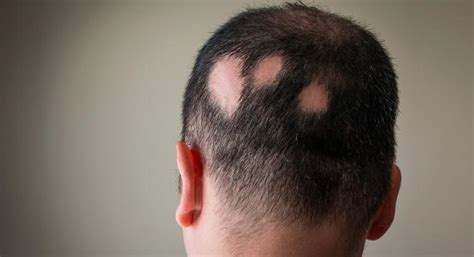 Alopecia Areata Qué Es Causas Síntomas Y Tratamiento
