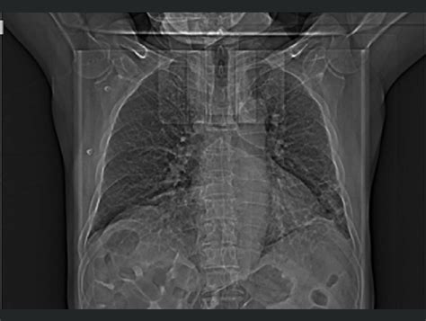 The Chest X Ray In The Posteroanterior View Shows Viral Pneumonia