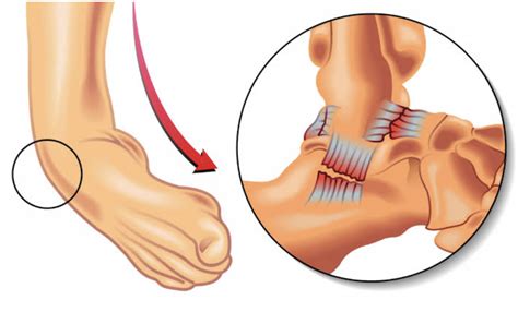 Qu Es Un Esguince De Tobillo Explora Fisioterapia Terapia F Sica