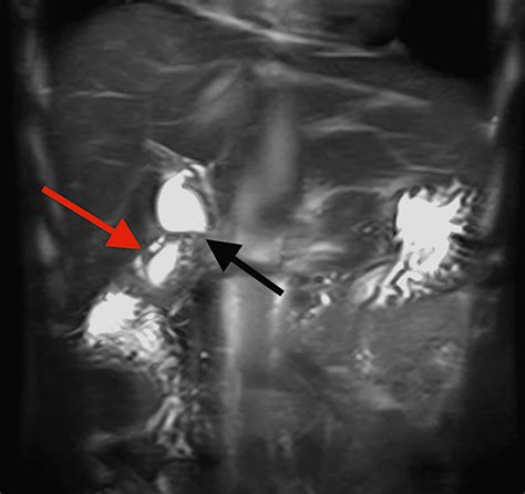 Cureus Gallbladder Adenomyomatosis Presenting With Abdominal Pain