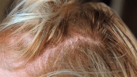 Contact Dermatitis Scalp Treatment Options Causes And Diagnosis