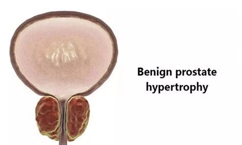 Rezum Safe Minimally Invasive Treatment For Lower Urinary Tract Symptoms Due To Benign Prostatic