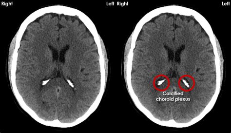 Ct Brain Anatomy Calcified Structures