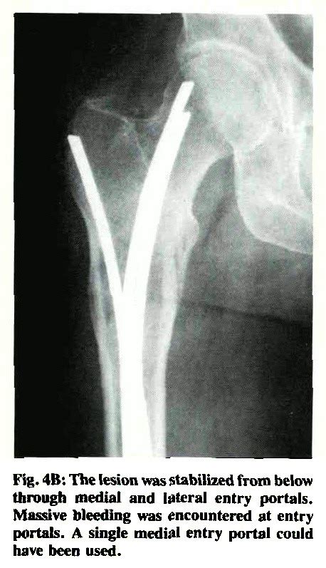 Treatment of Impending Pathological Fractures of the Femur ...
