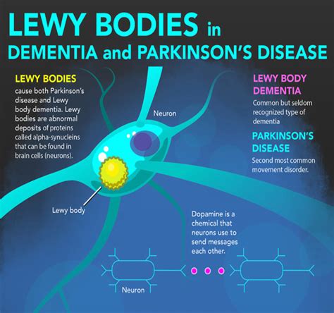 Lewy Bodies In Dementia And Parkinsons Disease Infographic Nih