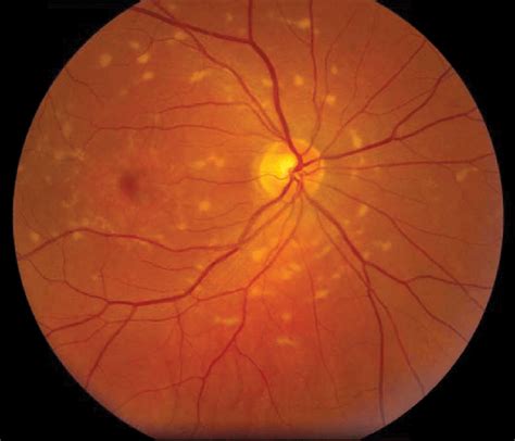 Fundus Photography Of A Patient With Stargardt Macular Dystrophy Shows