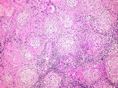 Sarcoidosis Fibrosis Of Granulomas A Photo On Flickriver