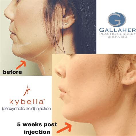 How Does Kybella® Work Blog Gallaher Plastic Surgery And Spa Md