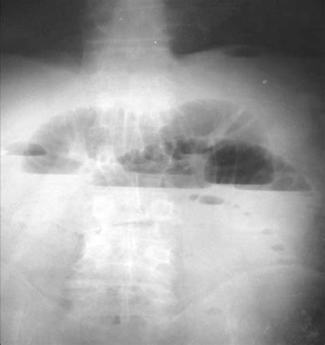 The Plain X Ray Of The Abdomen Shows The Air Fluid Levels In The