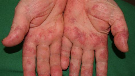 Liver Disease Itchy Skin Treatment