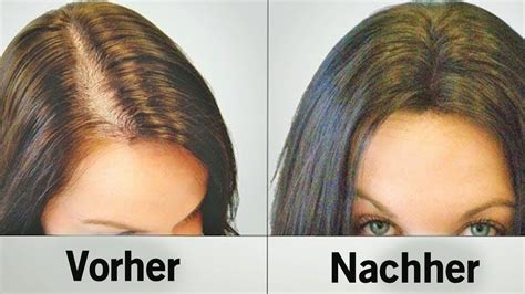 Es kräftigt die haare, verleiht die anwendung von rizinusöl, das auch kastoröl genannt wird, zur haarpflege ist einfach, aber zeitintensiv. Diese natÃ¼rlichen Hilfsmittel stoppen Haarausfall und ...