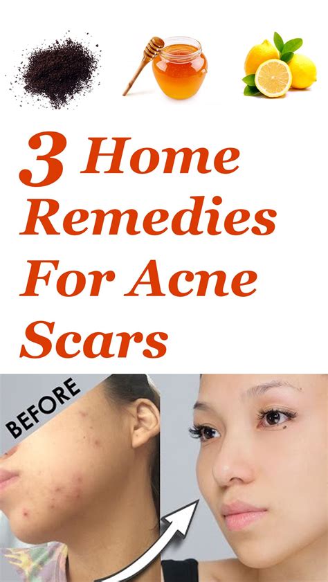 The pimple occurs on the face and other parts of the body such as the shoulders, back, and neck. Home remedies for pimple scars - NISHIOHMIYA-GOLF.COM