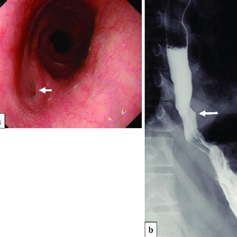 Endoscopic Findings And Esophagography After The Fourth Episode Fig