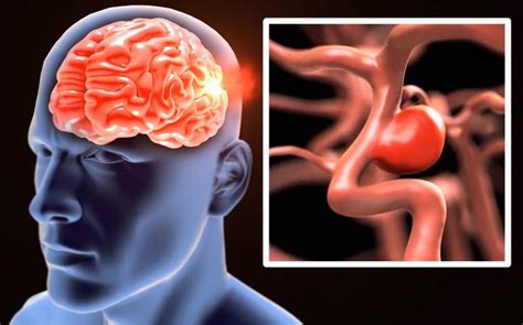 Tipos De Aneurisma Cerebral