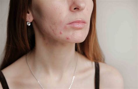 12 Sneaky Reasons Youre Having An Acne Breakout Readers Digest New