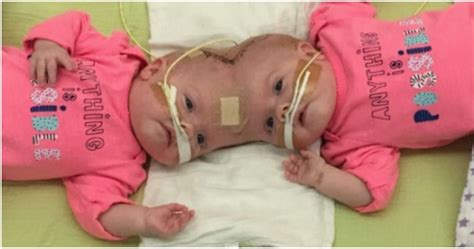 A Year After Their Separation Conjoined Twins Celebrate Their New Lives