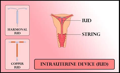 The Function Of Copper Ions In Copper Releasing Iuds Isa They Inhibit Ovulationb They