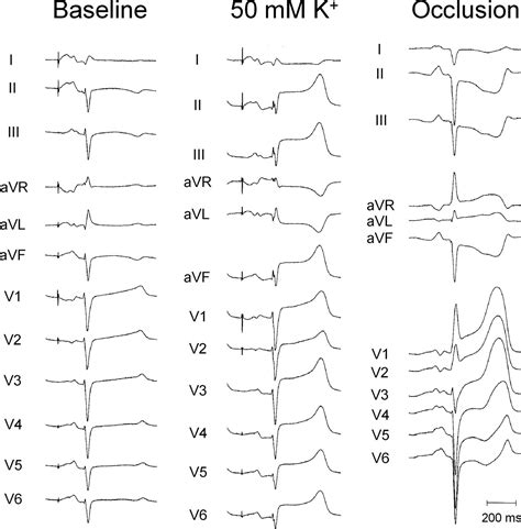 Changes In Qrs Duration And R Wave Amplitude In Electrocardiogram Leads