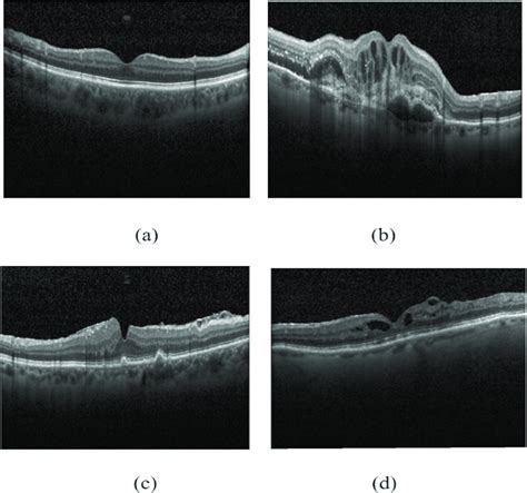 Retinal Oct Images Of A Normal B Cnv C Dmd D Dme Download