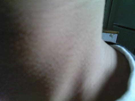 Chicken Skin Bumps On Neck Dorothee Padraig South West Skin Health Care