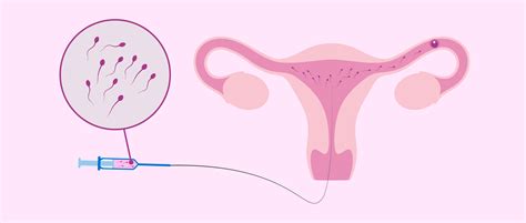How Does Intrauterine Insemination Iui Take Place