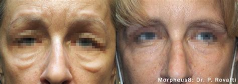 Treatment For Under Eye Bags And Dark Circles Morpheus 8 Los Angeles