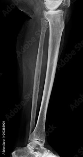 Lower Leg Xray X Ray Image Of Leg Side Latteral View Xray Of