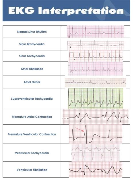 A complete guide to systematic ecg interpretation; Common EKG Heart Rhythms - Medical eStudy