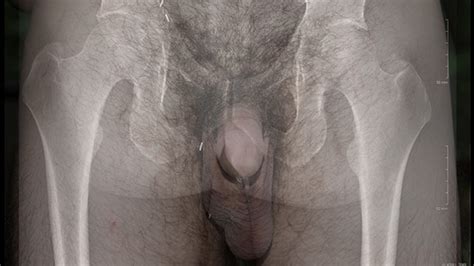 Pictures Showing For Deep Anal Sex X Ray Mypornarchive Net