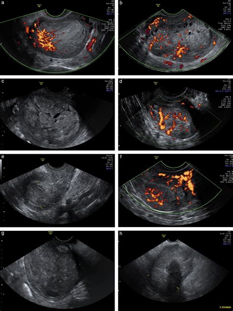 Uterine Cancer Ultrasound Images