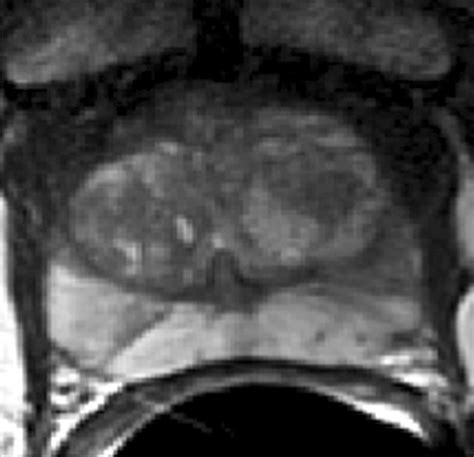 Prostate Cancer Managed With Active Surveillance Role Of Anatomic Mr Imaging And Mr