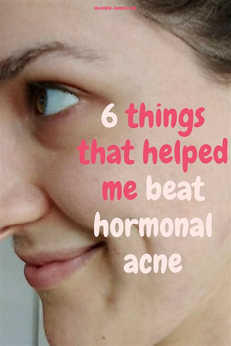 I beat hormonal acne: My 6 powerful little secrets | Hormonal acne