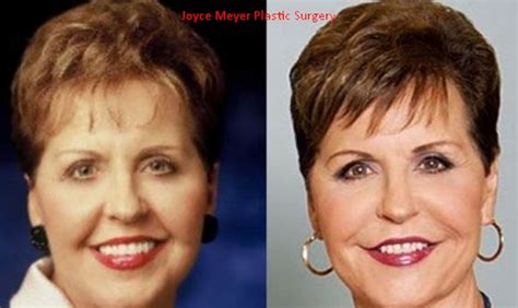 Updated Joyce Meyer Plastic Surgery Before After