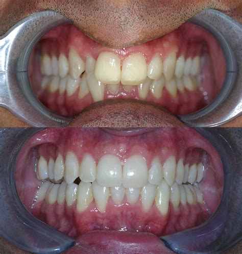 Before And After Invisalign Cosmetic Dentists Of Houston Cosmetic