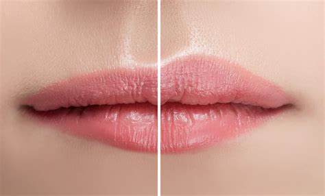What Is A Lip Flip With Botox Skin Vitality Blog Gta Ontario