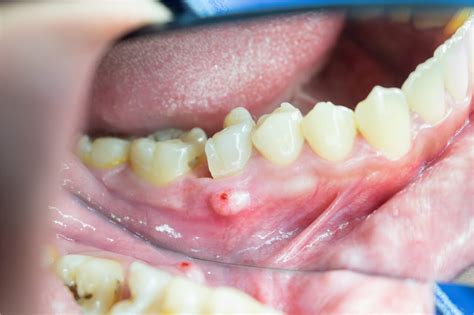 How To Get Rid Of Tooth Infection Naturally Rockville All Smiles