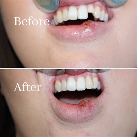 Broken Teeth Chipped Teeth Cracked Tooth Repair General Dentistry