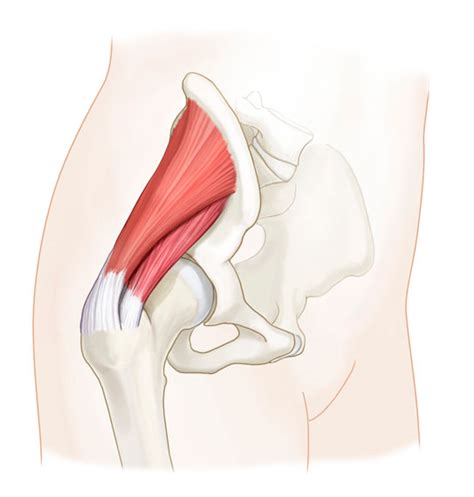 Abductor Tendon Injuries Gluteus Medius Gluteus Minimus Nashville Tn