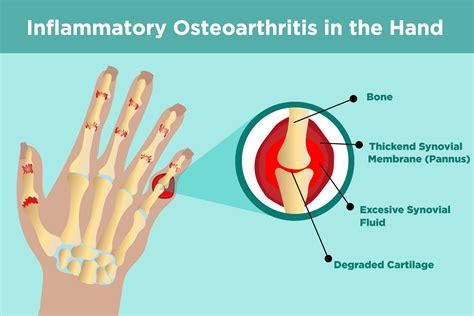 Unmasking Osteoarthritis And Osteoporosis A Guide To Early Detection