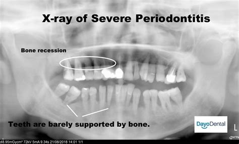 Your Ultimate Guide To Periodontal Disease Periodontitis