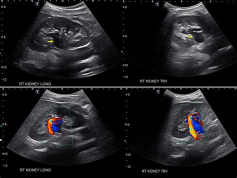 Top Panel Longitudinal And Transverse Gray‐scale Renal Ultrasound