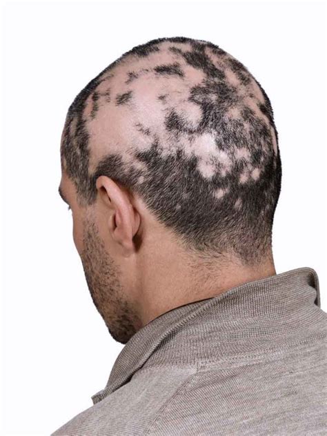 Alopecia Universal Síntomas Causas Y Tratamiento