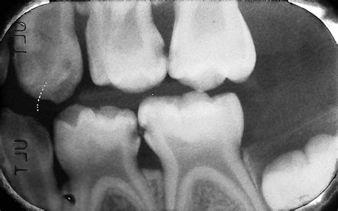 Dental X Rays Childrens Dental Ark New Braunfels Tx