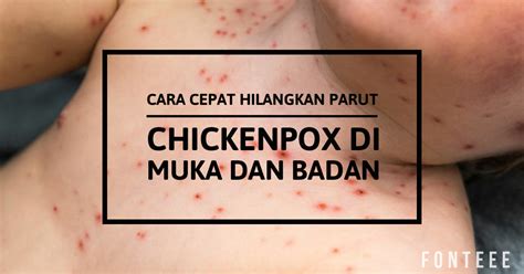 Tempelkan pada muka terutama pada bekas. Cara Cepat Hilangkan Parut Chickenpox Di Muka Dan Badan ...